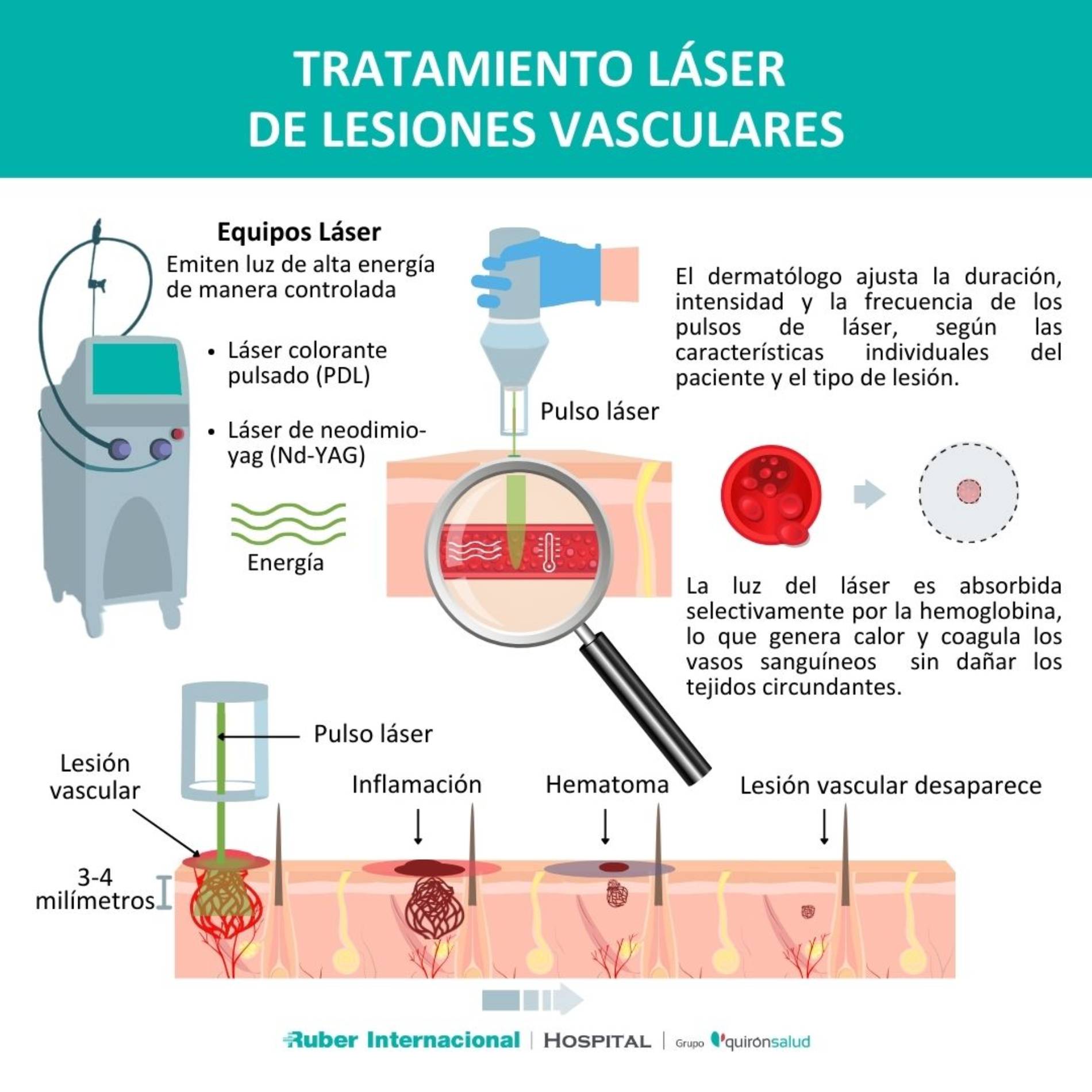 Láser Vascular Una Solución Segura Y Efectiva Para Las Lesiones